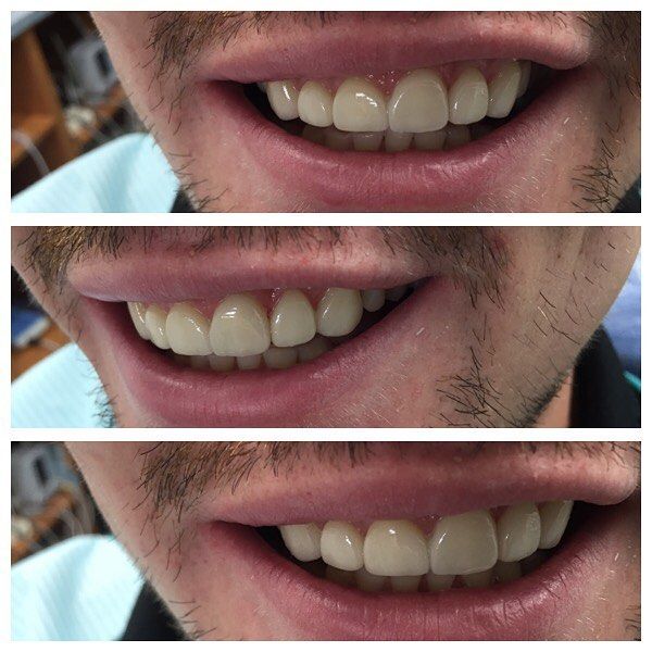 Does Any Insurance Cover Veneers All information about covid