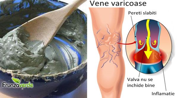 tratamentul venelor varicoase prin remedii populare în casa