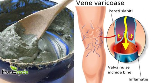 fitness pentru persoanele cu vene varicoase cum sa se ocupe de oetul venelor varicoase