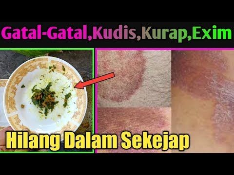 Cara Mengatasi Gatal Kulit Pada Anak Kulit Obat Alami Eksim