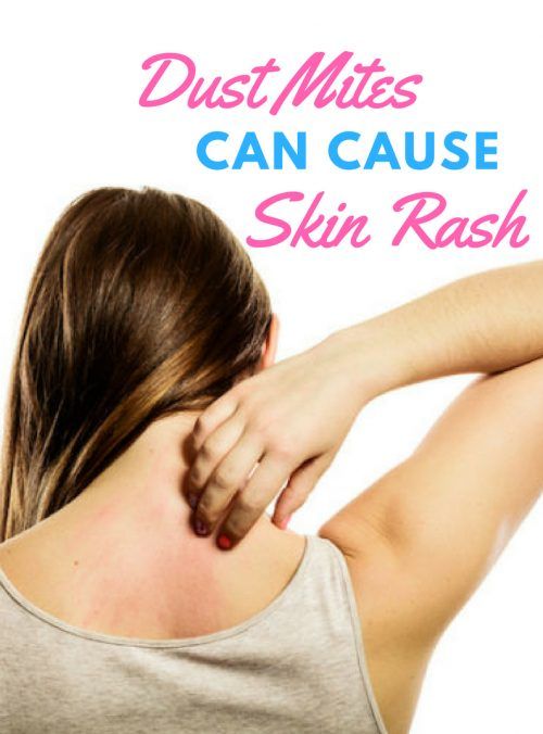 Dust Mite Allergy And Skin Rash 1 Eczema Itchy