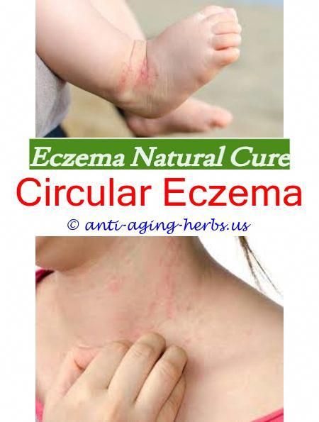 How #did #i #get #eczema.Does #eczema #hurt.Eczema #emperors #new #groove #- #Eczema #Cure. #4928375766 # #EczemaLotion # #medicationstotreateczema