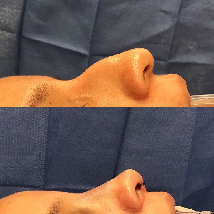Are Septoplasty Covered By Insurance
