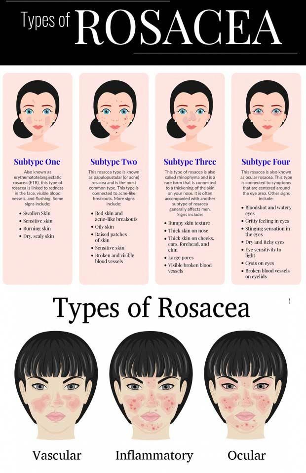 vitamins for rosacea vitamins for rosacea