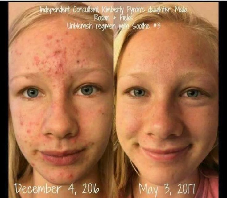 UNBLEMISH™ before and after | Skincare in 2019 | Rodan ...