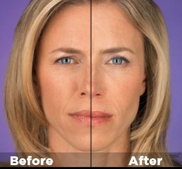 Anew clinical advanced wrinkle corrector adverse