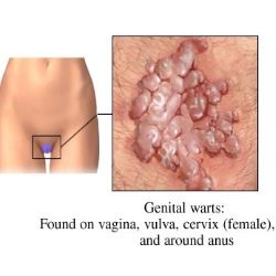 How To Shrink Your Labia Naturally At Home How To Shrink Your Labia Naturally At Home