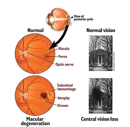 31 best MACULAR images on Pinterest Eye facts, Eyes and Health - presumed ocular histoplasmosis 31 best MACULAR images on Pinterest Eye facts, Eyes and Health - presumed ocular histoplasmosis