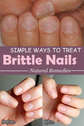 Simple Ways To Treat Brittle Nails Beauty Tricks Pinterest Simple Ways To Treat Brittle Nails Beauty Tricks Pinterest And Hacks