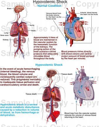 Nursing case study hypovolemic shock