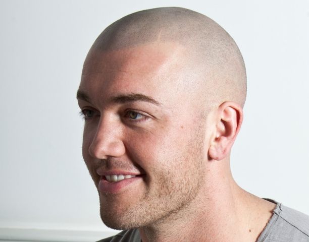 michael amazing scalp micropigmentation result after michael amazing scalp micropigmentation result after