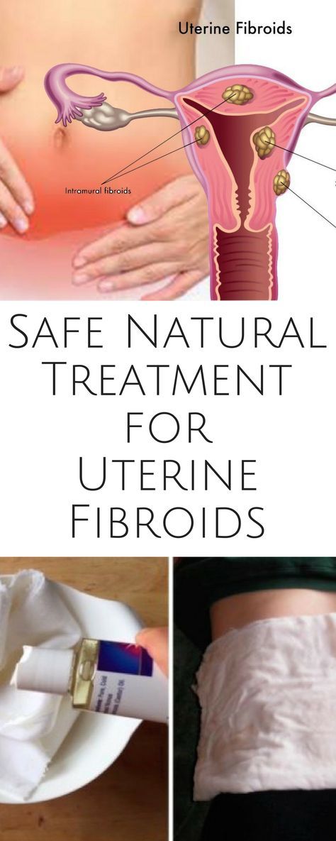 Cyst And Fibroids Natural Cure Cyst And Fibroids Natural Cure