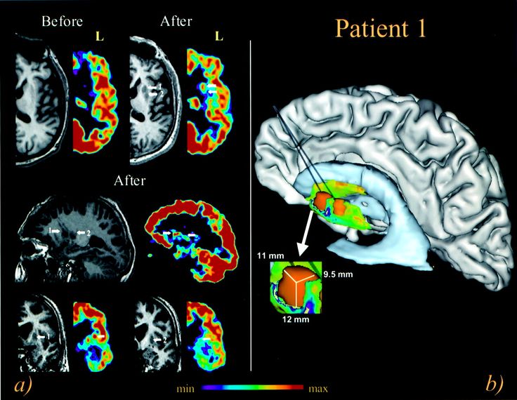 Huntingtons disease dementia