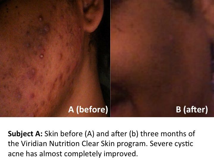 clear skin complex clear skin complex