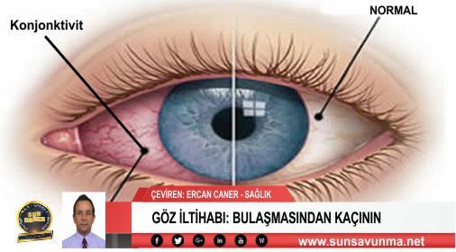 Goz Iltihabi Bulasmasindan Kacinin Gozler Saglik Bilgi Goz Iltihabi Bulasmasindan Kacinin Gozler Saglik Bilgi