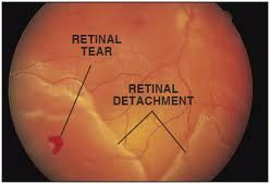 How To Treat Retinal Detachment Naturally How To Treat Retinal Detachment Naturally