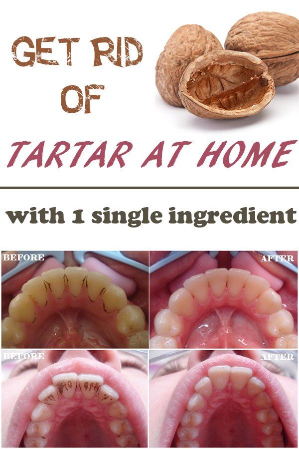 Home Remedies For Cleaning Your Dogs Teeth Home Remedies For Cleaning Your Dogs Teeth