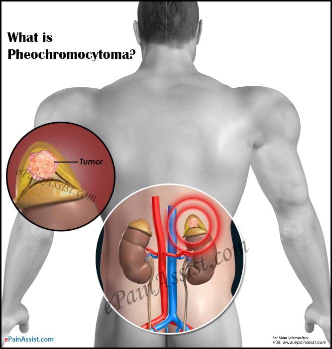 Pheochromocytoma with weight gain
