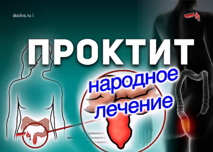 Types of Ulcerative Colitis (UC), ulcerative colitis - cvu.by