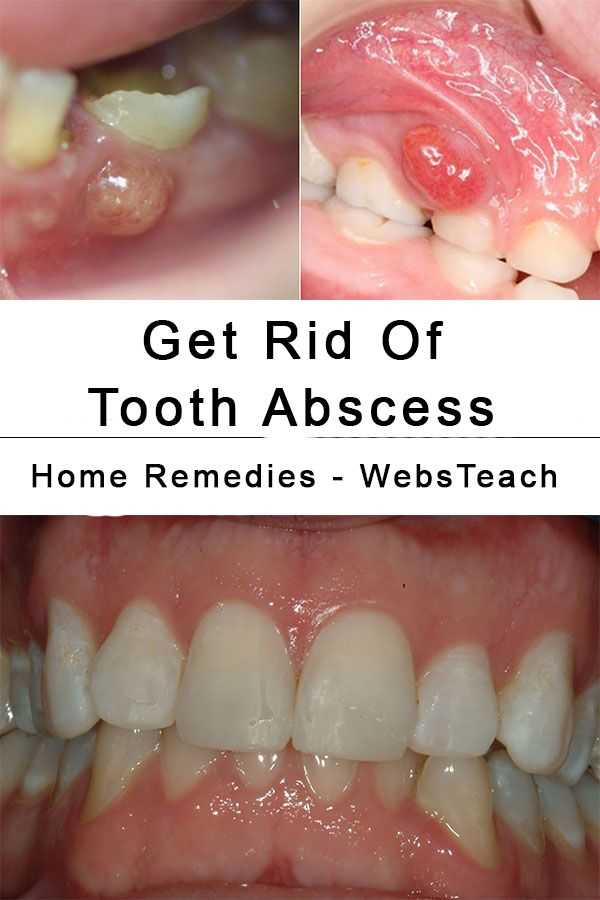 Natural Way To Get Rid Of A Tooth Infection Natural Way To Get Rid Of A Tooth Infection
