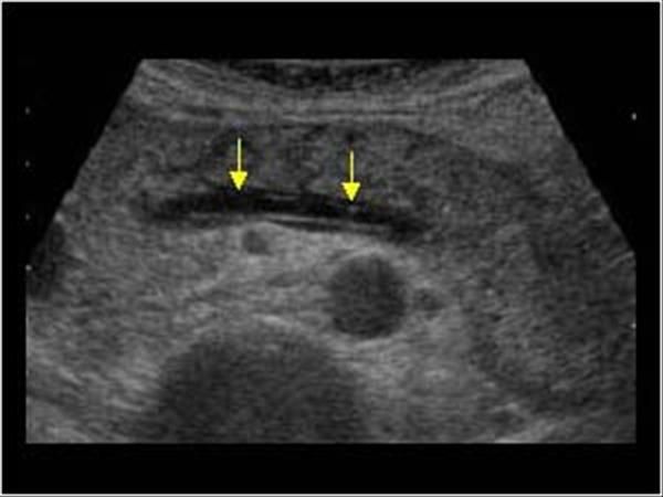 Hepatic adenoma Radiology Reference Article Radiopaedia.org Ultrasound sonograph