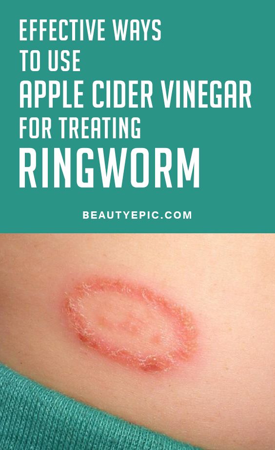 Ways To Cure Ringworm Naturally Ways To Cure Ringworm Naturally