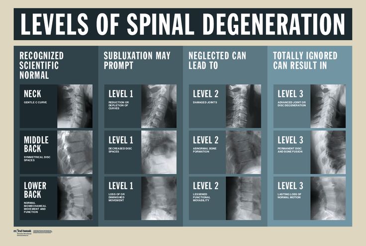 Image Result For Phases Of Spinal Degeneration Spinal Degeneration image-result-for-phases-of-spinal-degeneration-spinal-degeneration