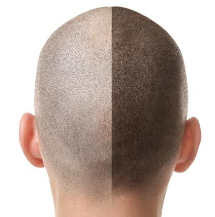 Hair Transplant Techniques Comparison Table