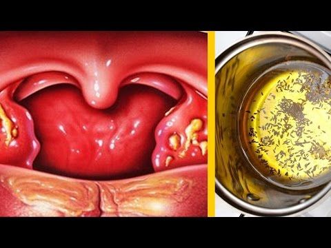 Youtube Remedios Para La Amigdalitis Remedios Para Las Anginas Amigdalitis