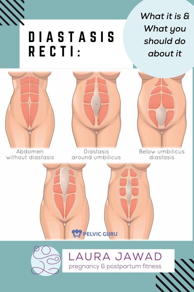 The Real Deal With Diastasis Recti What It Is Why It s A Problem And the-real-deal-with-diastasis-recti-what-it-is-why-it-s-a-problem-and