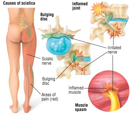 108 best Health - Sciatica images on Pinterest | Sciatica pain ... 108 best Health - Sciatica images on Pinterest | Sciatica pain ...