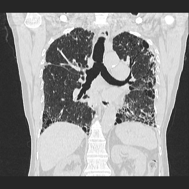 Usual Interstitial Pneumonia UIP Refers To A Morphological Pattern Best Uip Pattern Usual Interstitial Pneumonia UIP Refers To A Morphological Pattern Best Uip Pattern