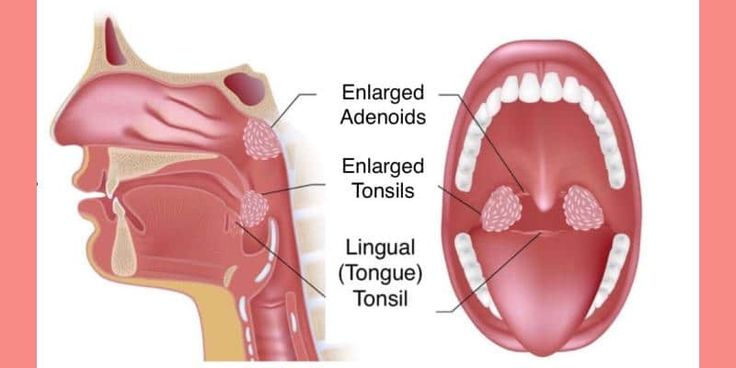 Как выглядят увеличенные миндалины у детей Daniel Rusev presents a case of chronic tonsillitis and adenoiditis in a boy of 