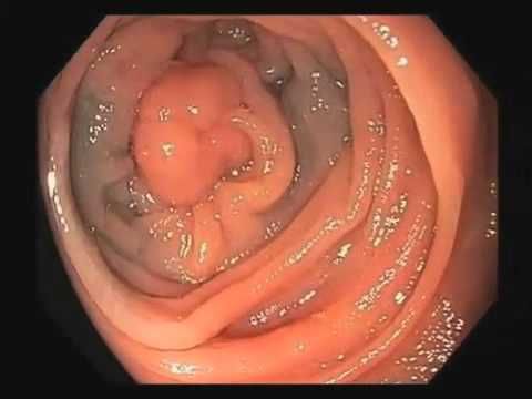 Image Result For Colon Cancer Year Old Image Result For Colon Cancer Year Old