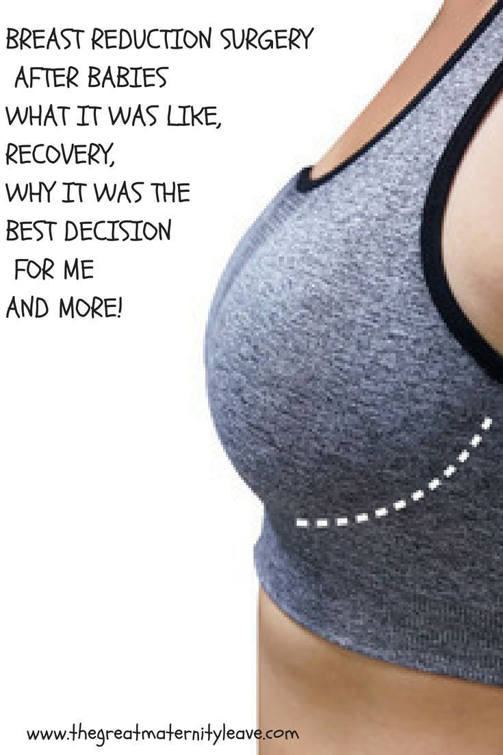 Breast reduction, breast reduction surgery, breast reduction surgery recovery, recovery from breast reduction, breast reduction after babies, breast reductions, breast reduction advice, breast reduction tips, breast lift, breast lift after babies