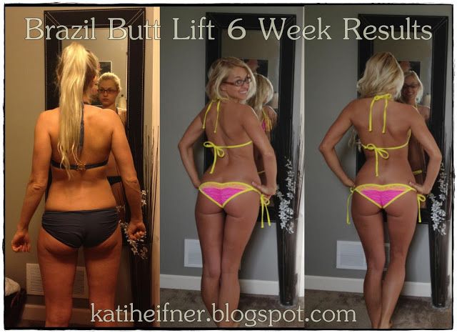 15 Full Body Bbl workout before and after for ABS