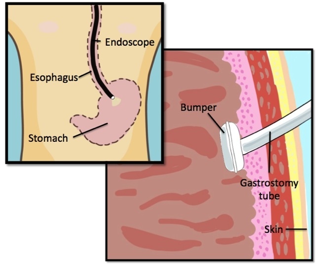21 best G-tubes and Ostomies images on Pinterest Nursing - wound ostomy continence nurse sample resume 21 best G-tubes and Ostomies images on Pinterest Nursing - wound ostomy continence nurse sample resume