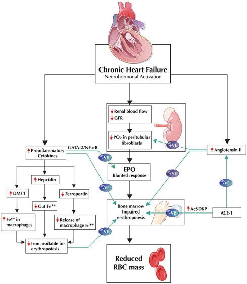 pathophysiology of chf Congestive heart failure (chf) complicates the course of a significant proportion of patients in the intensive care unit (icu) in the icu, chf may present as a manifestation of newly diagnosed cardiac disease or as an exacerbation of underlying heart disease, as a result of fluid overload or stress. pathophysiology of chf Congestive heart failure (chf) complicates the course of a significant proportion of patients in the intensive care unit (icu) in the icu, chf may present as a manifestation of newly diagnosed cardiac disease or as an exacerbation of underlying heart disease, as a result of fluid overload or stress.