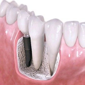 Best affordable option teeth replacement