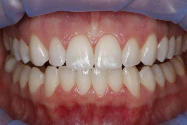 A Simple Way To Treat White Spot Lesions | Teeth after ...
