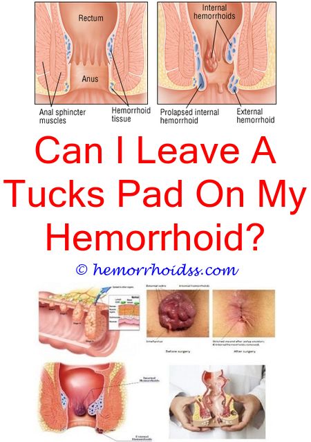 anal gas hemroids Anal gas hemroids