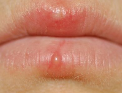 blister on lip not cold sore water white blood causes how to get rid of camel toe