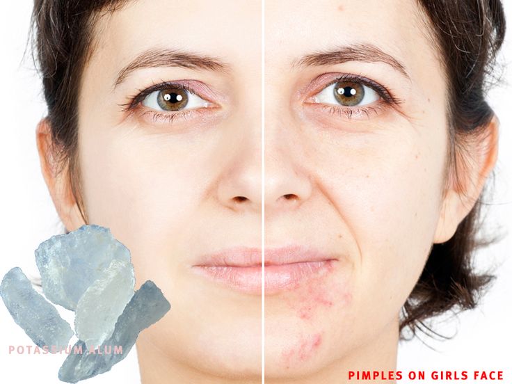 Pimples treatment