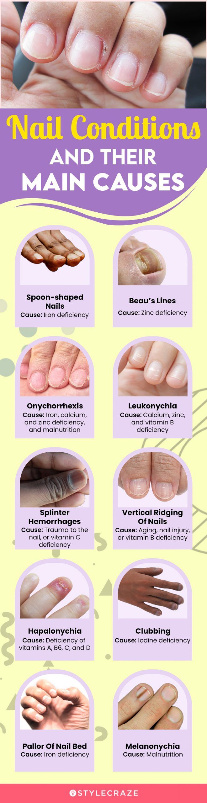 Effects Of Nutrient Deficiency On The Nails What Do They Indicate effects-of-nutrient-deficiency-on-the-nails-what-do-they-indicate
