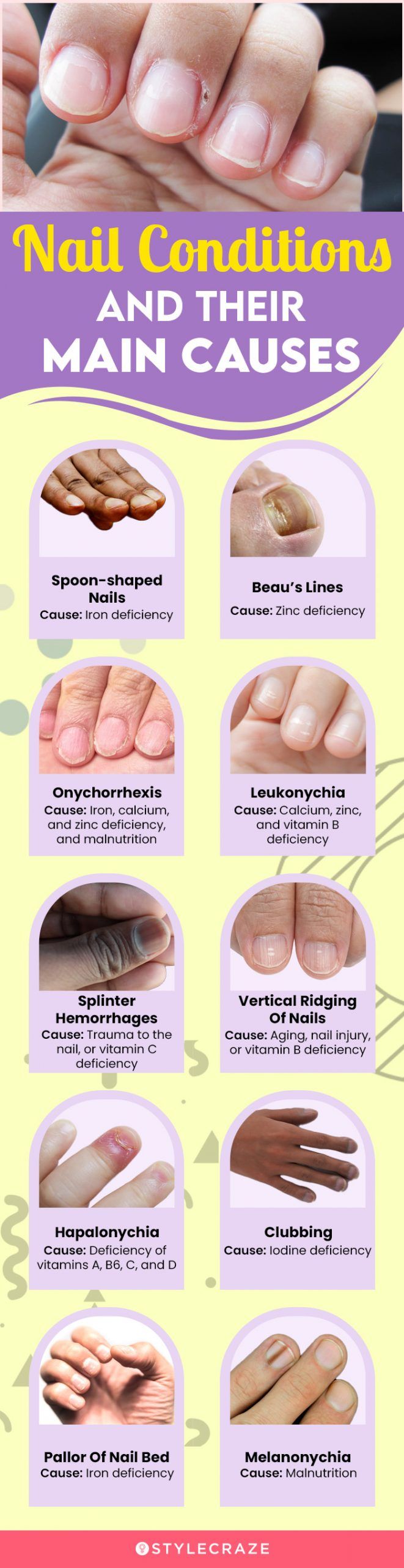 What you need to know about pseudomonas nail infections aka 