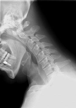X-ray of cervical spine (neck) in flexion (bending forward). The facet joints ar...