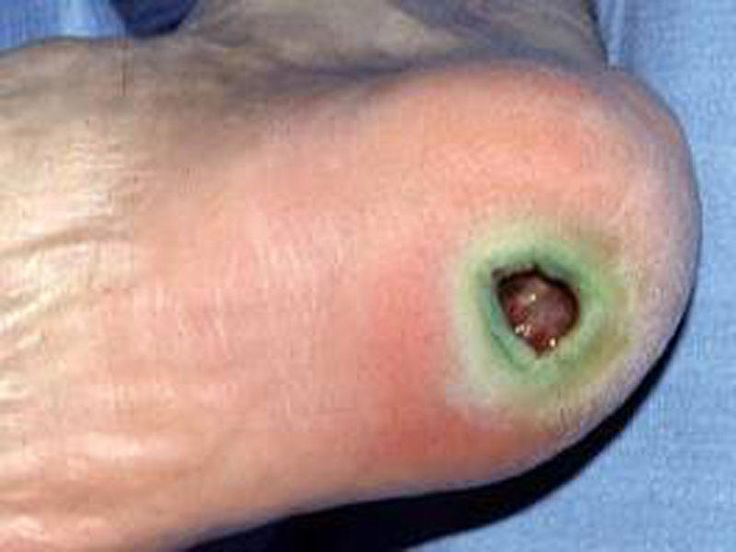 mercers disease