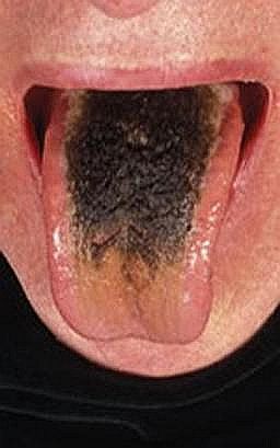 You May Have A Condition Called Black Tongue Without Black Tongue