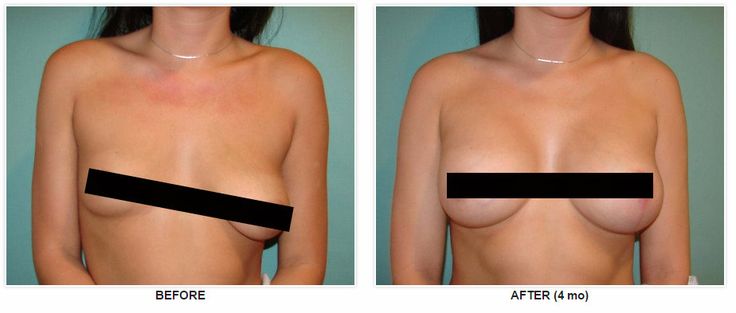 Has breast augumentation b cup think, that Breast augumentation b cup agree, this