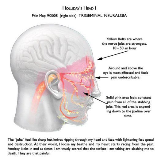 Occipital neuralgia cause facial pain Male domination clips